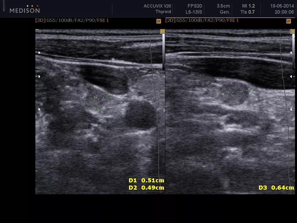 Медуллярная карцинома щитовидной железы на УЗИ. Сонография щитовидной железы. Фолликулярная неоплазия щитовидной железы УЗИ. Как выглядят узлы в щитовидной железе на УЗИ. Цдк лимфоузлов