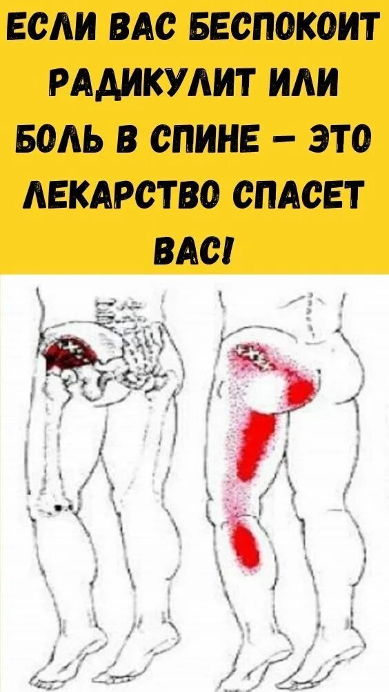 Радикулит долго. Радикулит прикол. радикулит картинки прикольные. радикулит смешные картинки. радикулит поясничный.