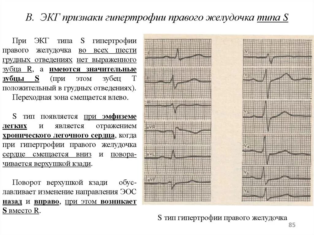 Нарастание зубца r. ЭКГ зубец р гипертрофия левого желудочка. S Тип гипертрофии левого желудочка. Гипертрофия отделов сердца на ЭКГ. ЭКГ критерии гипертрофии правого желудочка.