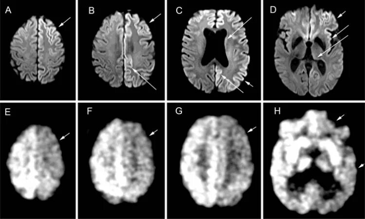 Нейродегенеративное заболевание головного. Нейродегенеративные заболевания головного мозга. Нейродегенеративные изменения на мрт. Нейродегенеративные заболевания мрт.