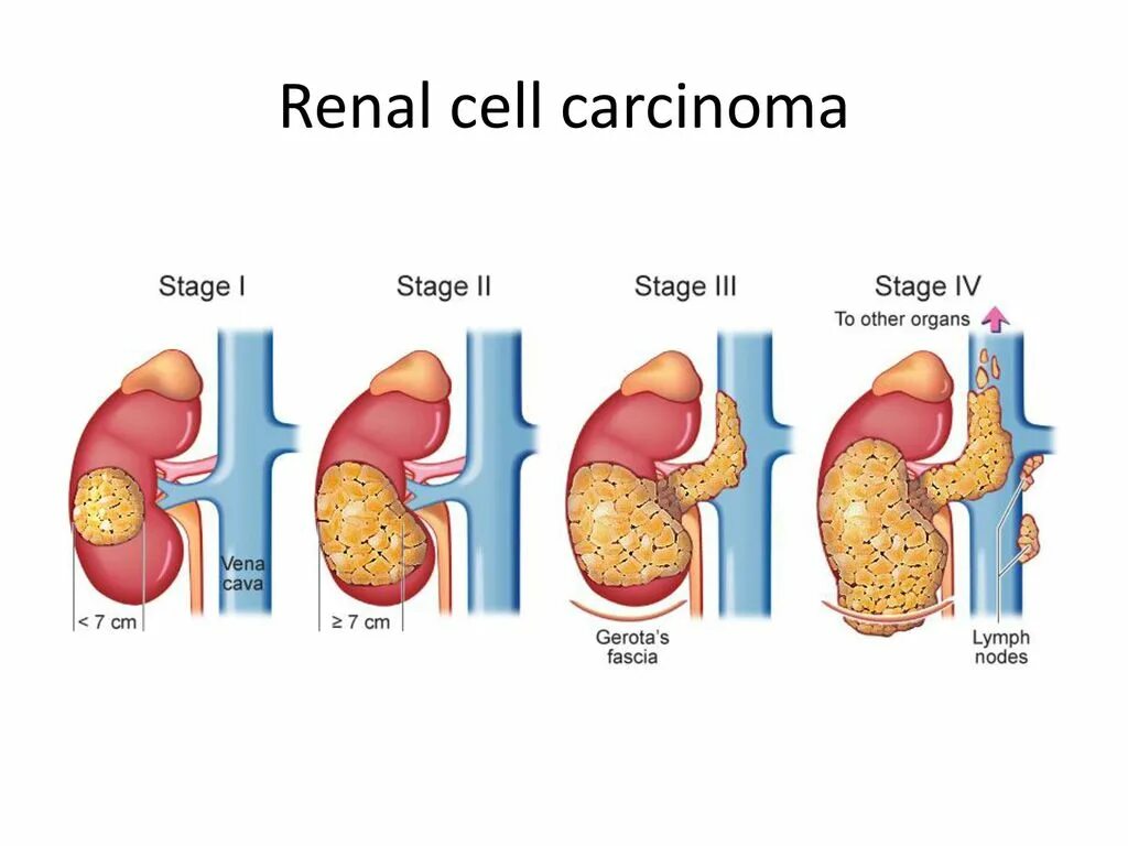 Новообразование 4 степени почки. Опухоль почки классификация ТНМ. Онкология почек стадии. Рак почки рекомендации