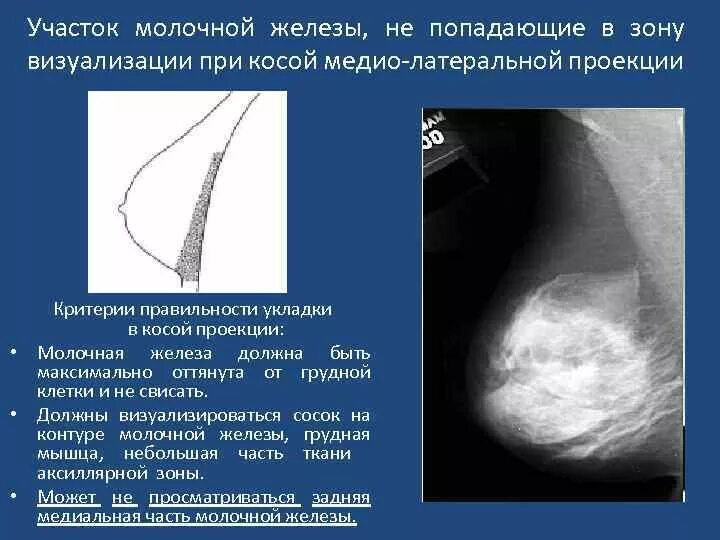 Доле груди. Косая проекция молочной железы. Рентгенодиагностика заболеваний молочной железы. Нормальная рентгеноанатомия молочной железы.