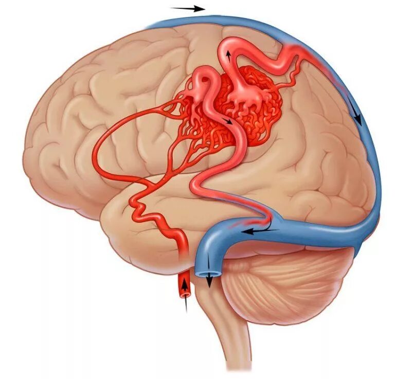 Сосудистая аномалия. Мальформация сосудов головного мозга. АВМ мальформация сосудов головного мозга. Артерия венозная мальформация головного мозга. Эмболизация АВМ сосудов головного мозга.