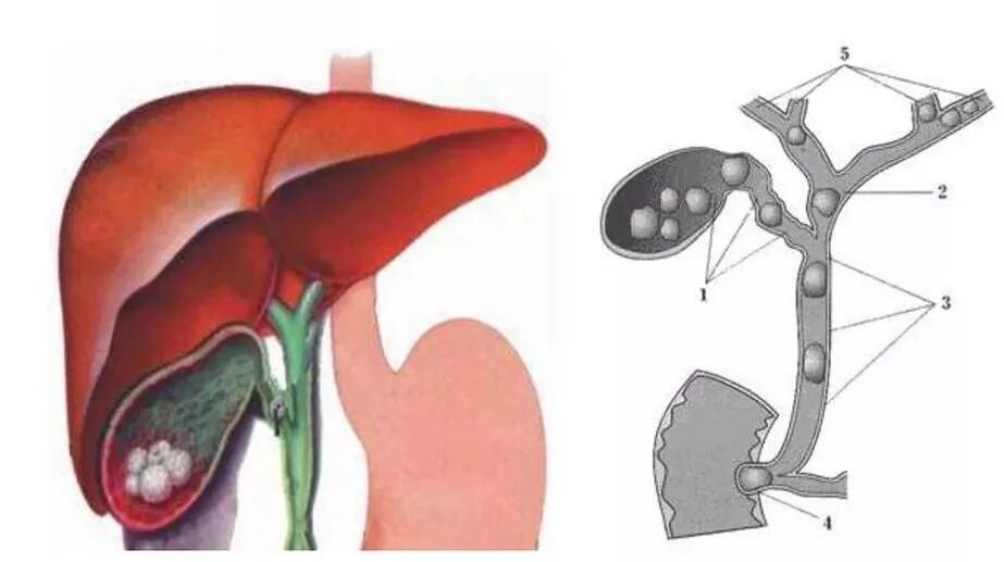 Как желчный пузырь влияет на печень. Холестаза желчного пузыря. Холестаз желчного пузыря симптомы. Внепеченочный холестаз печени.