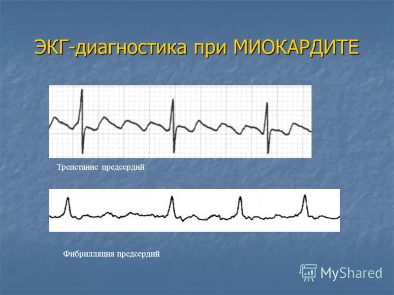 Изменения миокарда предсердий. ЭКГ при миокардите. Изменения на ЭКГ при миокардите. Вирусный миокардит ЭКГ. Электрокардиограмма при миокардите.