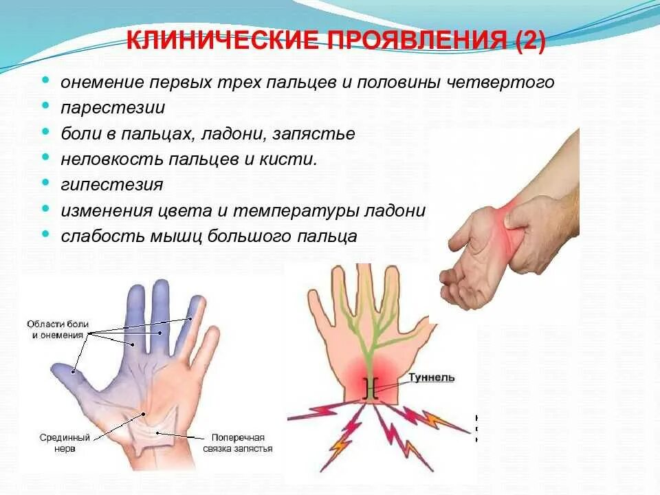 Синдром запястного канала руки. Туннельный синдром запястья кисти. Костевой ьуннельный синжрлм. Синдром лучезапястного канала. Почему происходит онемение
