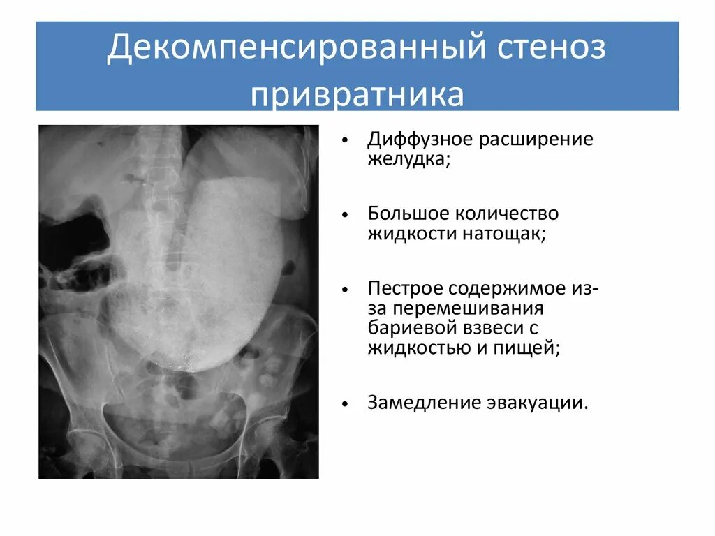 Характерный симптом декомпенсированного стеноза привратника. Стеноз выходного отдела желудка рентген. Стеноз привратника рентгенограмма. Субкомпенсированный стеноз желудка рентген. Стеноз прямой