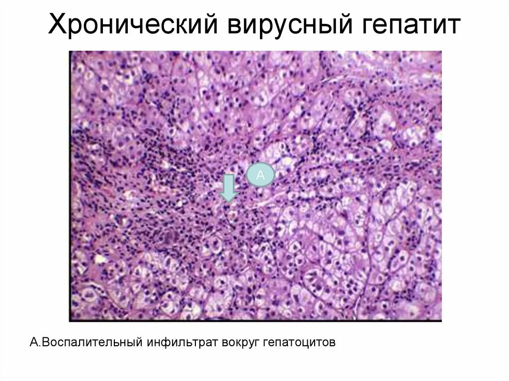 Интегративный гепатит. Хронический активный гепатит микропрепарат. вирусный гепатит микропрепарат. хронический гепатит микропрепарат. хронический активный вирусный гепатит микропрепарат.