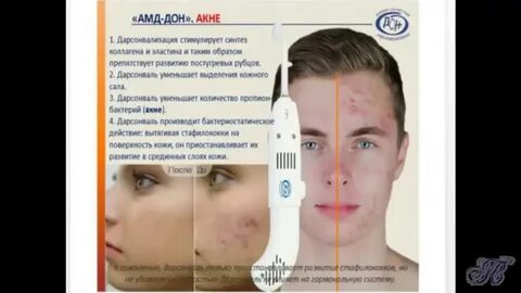 Дарсонваль болит голова