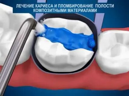 Пломбирование кариозных полостей