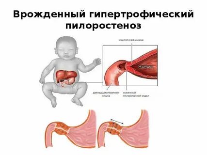 Стеноз у новорожденных