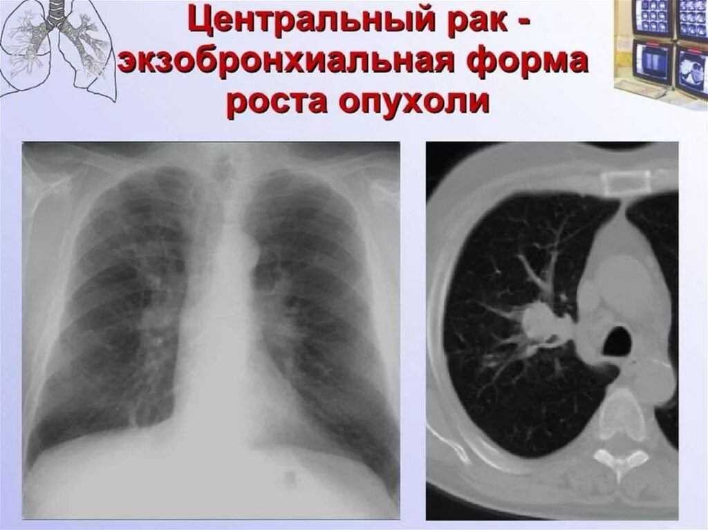 Эндобронхиальная опухоль. Центральная карцинома легкого. Центральные опухоли легких. Экзобронхиальный рост. Центральный рак правого