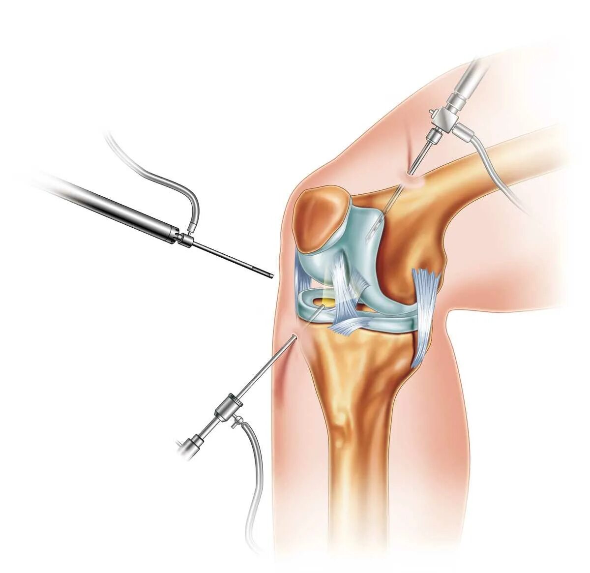 Артроскопия мениска коленного сустава операция. Артроскопическая резекция мениска коленного сустава. Артроскопия коленного сустава разрыв мениска.