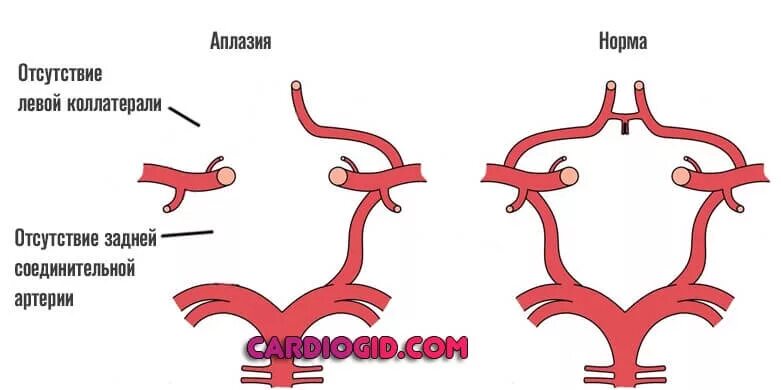 Аплазия соединительных артерий Виллизиева круга. Задние соединительные артерии Виллизиева круга. Артерии головного мозга Виллизиев круг. Аплазия передней соединительной артерии головного мозга. Гипоплазия правой артерии мозга