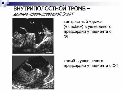 Тромб ушка левого предсердия
