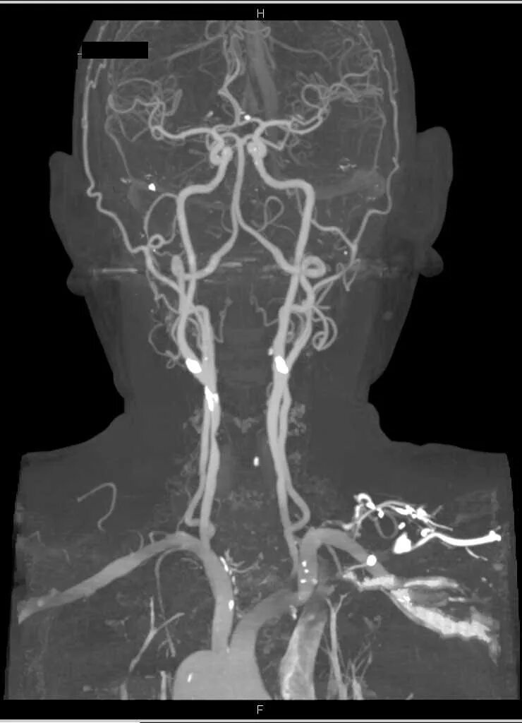 Интракраниальные артерии головного мозга. Кт ангиография брахиоцефальных артерий. Магнитно-резонансная-ангиография артерий шеи. Брахиоцефальные артерии кт. Кт ангиография сонных артерий.