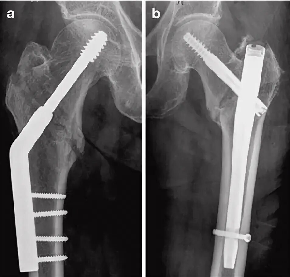 Остеосинтез операция пластины. Интрамедуллярный остеосинтез шейки бедра гамма. Остеосинтез DHS фиксатором. DHS пластина остеосинтез бедра. Остеосинтез винтами при переломе шейки бедра.