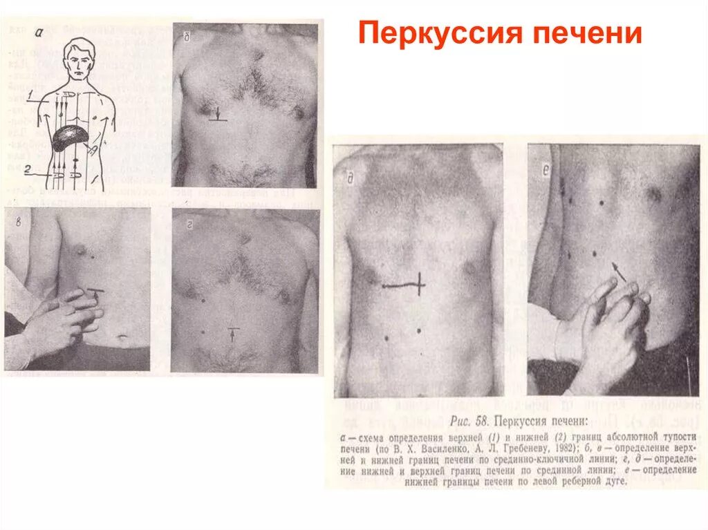 Границы печени линии. Техника перкуссии печени по курлову. Перкуссия печени Курлов. Границы печени перкуссия. Перкуссия печени по курлову алгоритм.