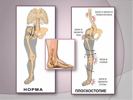 Сколиоз болит нога