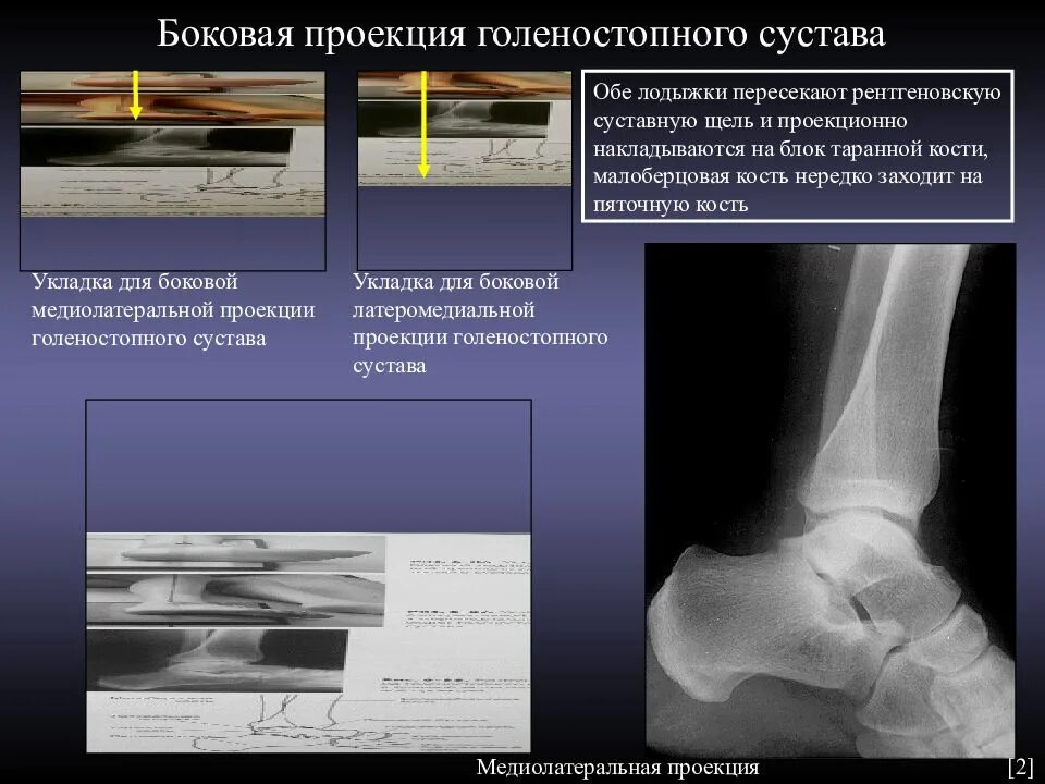 Голеностоп рентген анатомия. Голеностопный сустав рентген норма. Голеностопный сустав в боковой проекции. Голеностопный сустав рентген укладка.