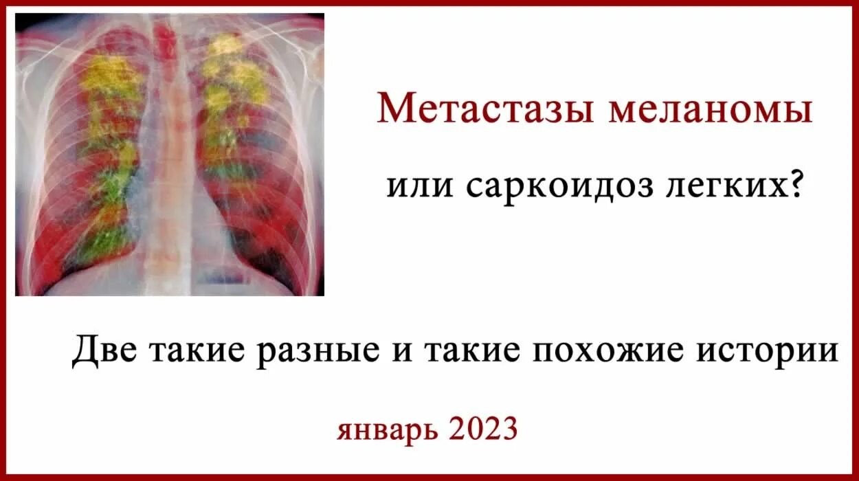 Продолжительность жизни при метастазах. Метастазы в легких симптомы. Метастазы пошли на легкие.