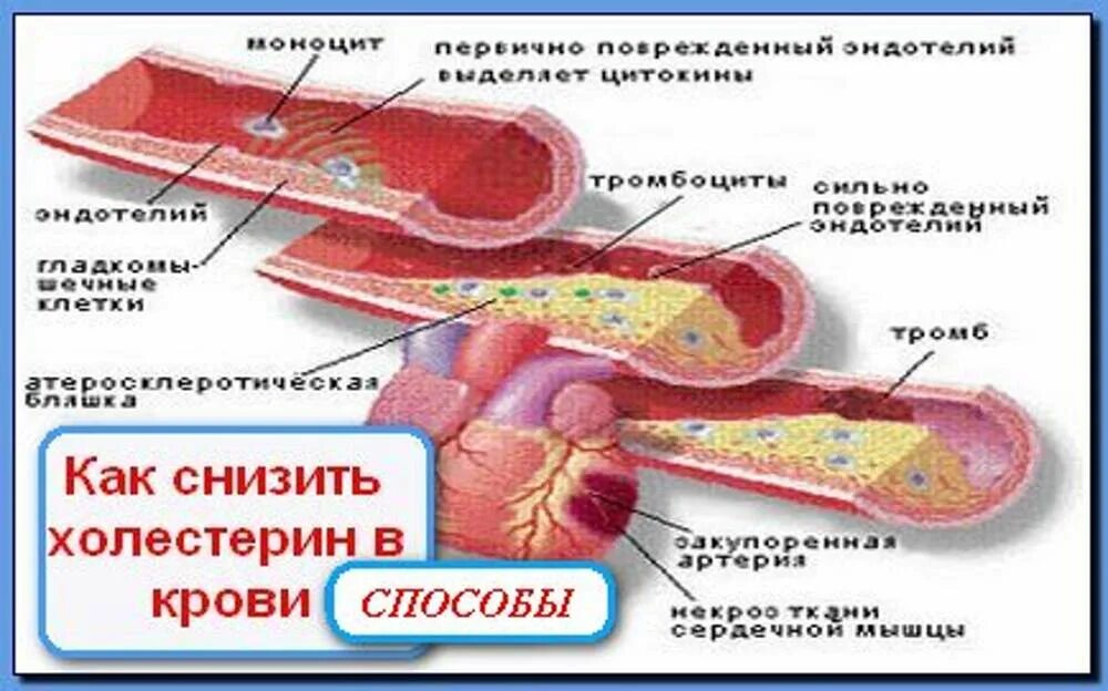 Высокий холестерин в крови. Причины повышенного холестерина в крови. Повышение холестерина в крови ведет к. Повышен холестерин в крови. Повышенный холестерин в крови причины.