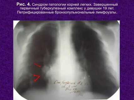 Бронхопульмональные лимфоузлы