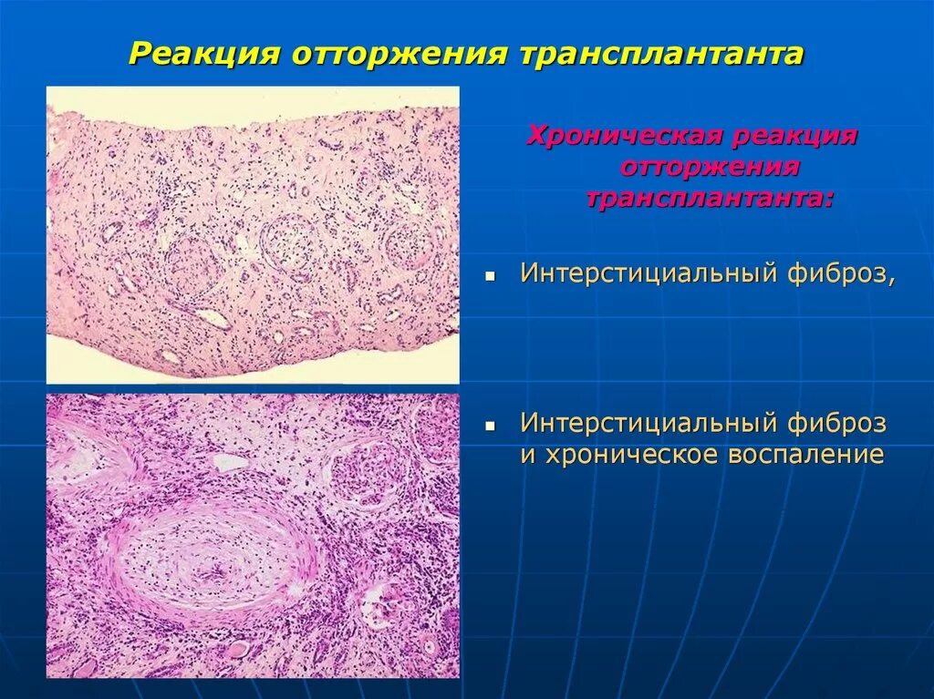 Трансплантант. Реакция отторжения трансплантата. Хроническая реакция отторжения трансплантата. Отторжение трансплантата патанатомия. Реакции гиперчувствительности отторжение трансплантата.