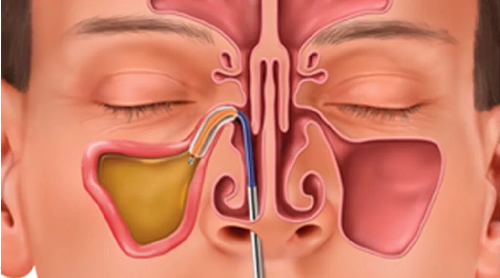 Запах железа носу железы. Синусит гайморовых пазух. Синусит верхнечелюстной пазухи. Прокол (пункция) гайморовой пазухи. Гайморовы пазухи человека 3д.