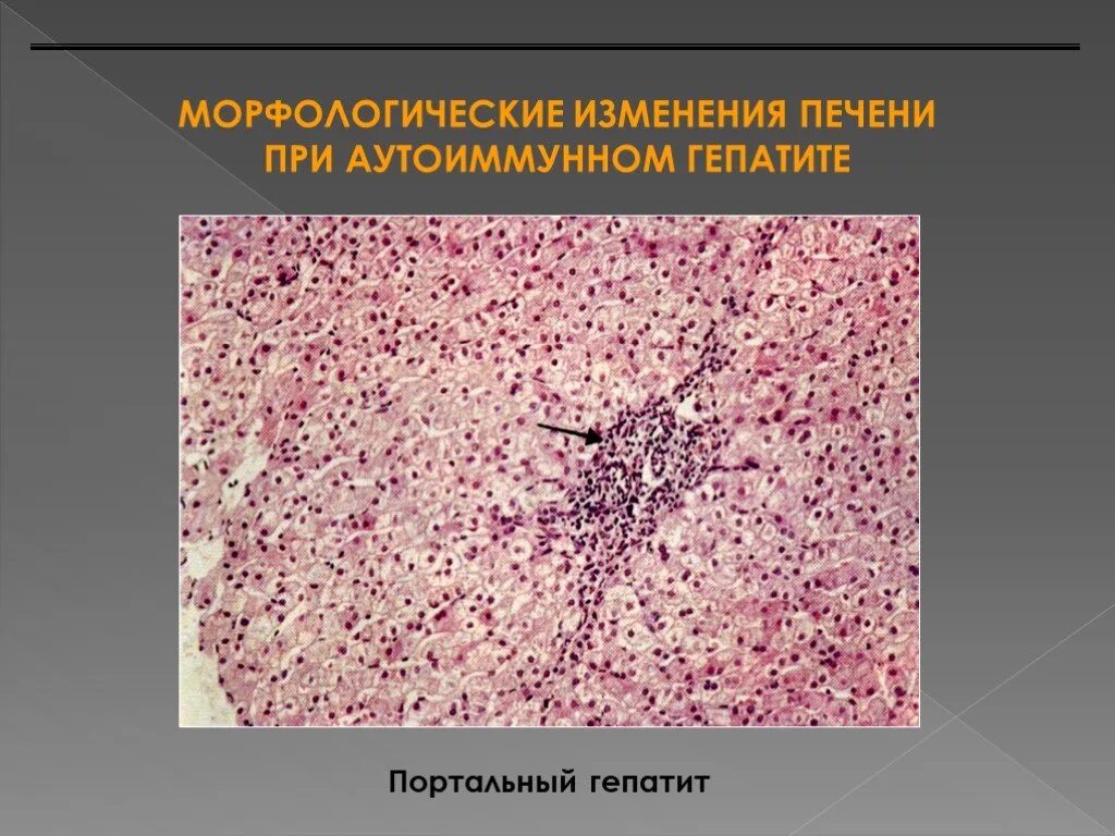 Клетки печени разрушаются. Гепатит печени патанатомия. Патоморфология аутоиммунного гепатита. Гепатит гистология микропрепарат. Аутоиммунный гепатит патанатомия.