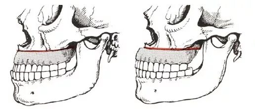 движение верхней челюсти. фронтальная ось движения внчс. решетчатая компактостеотомия нижней челюсти. движение верхней челюсти. движение височно нижней челюсти сустав.
