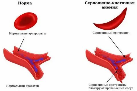 Серповидно клеточные нарушения по утвержденным клиническим рекомендациям