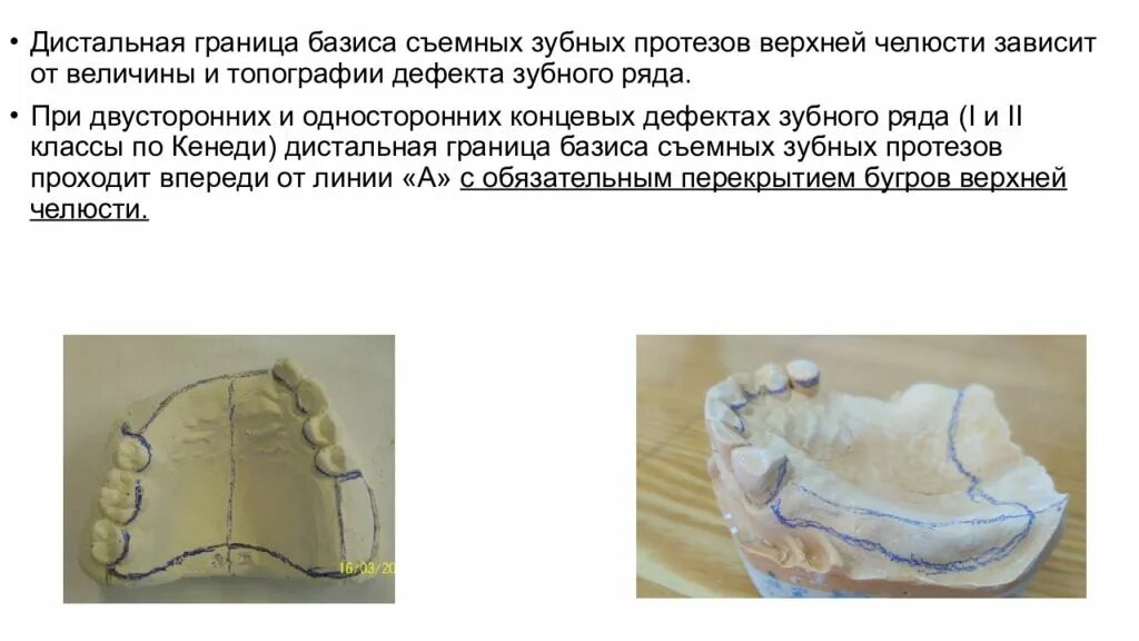 Длина базиса. Границы базиса ЧСПП на верхней челюсти. Границы базиса протеза на верхней челюсти. Граница базиса протеза на нижней челюсти. Границы частичного съемного протеза.