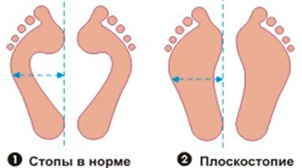 Продольное и поперечное плоскостопие 2 степени. Плоскостопие 3й степени градусы. Плоскостопие 1 2 3 степени. Показатели третьей степени плоскостопия. 2 степень плоскостопия стопа.