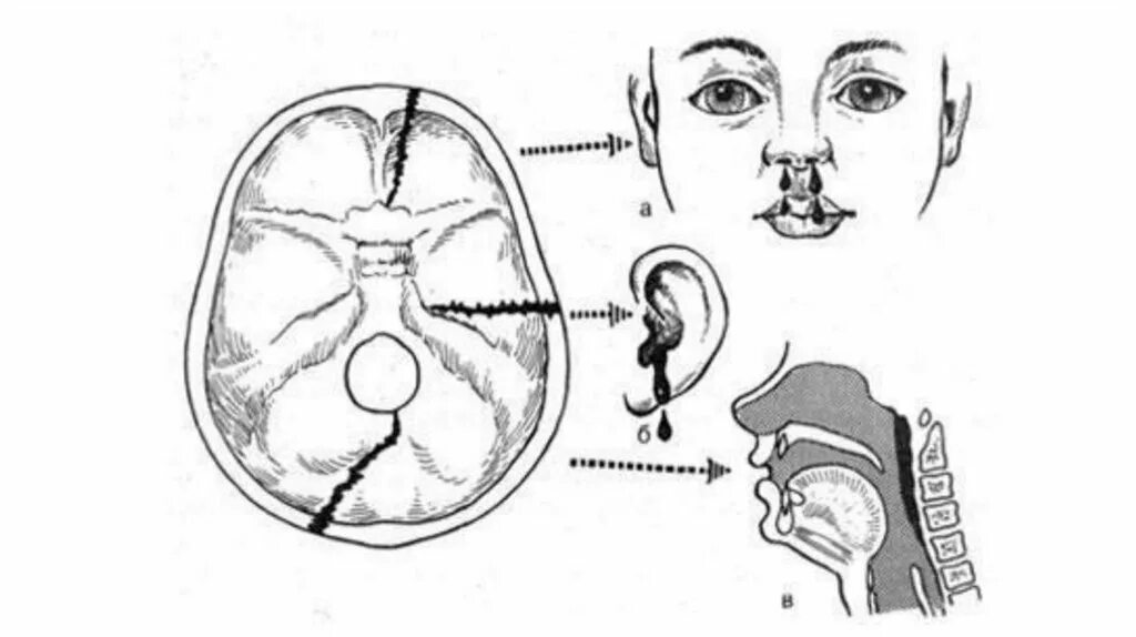 Для перелома основания черепа характерно. Ликворея при переломе основания черепа. Перелом свода основания черепа. Переломы основания черепа передней черепной ямки. Перелом основания черепа механизм.
