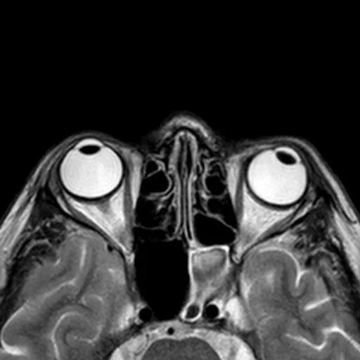 Глазных орбит и зрительных нервов. Экзофтальм на кт. Мрт глазницы и зрительного нерва. Мрт орбит и зрительных нервов. Мрт головного мозга и глазных орбит.