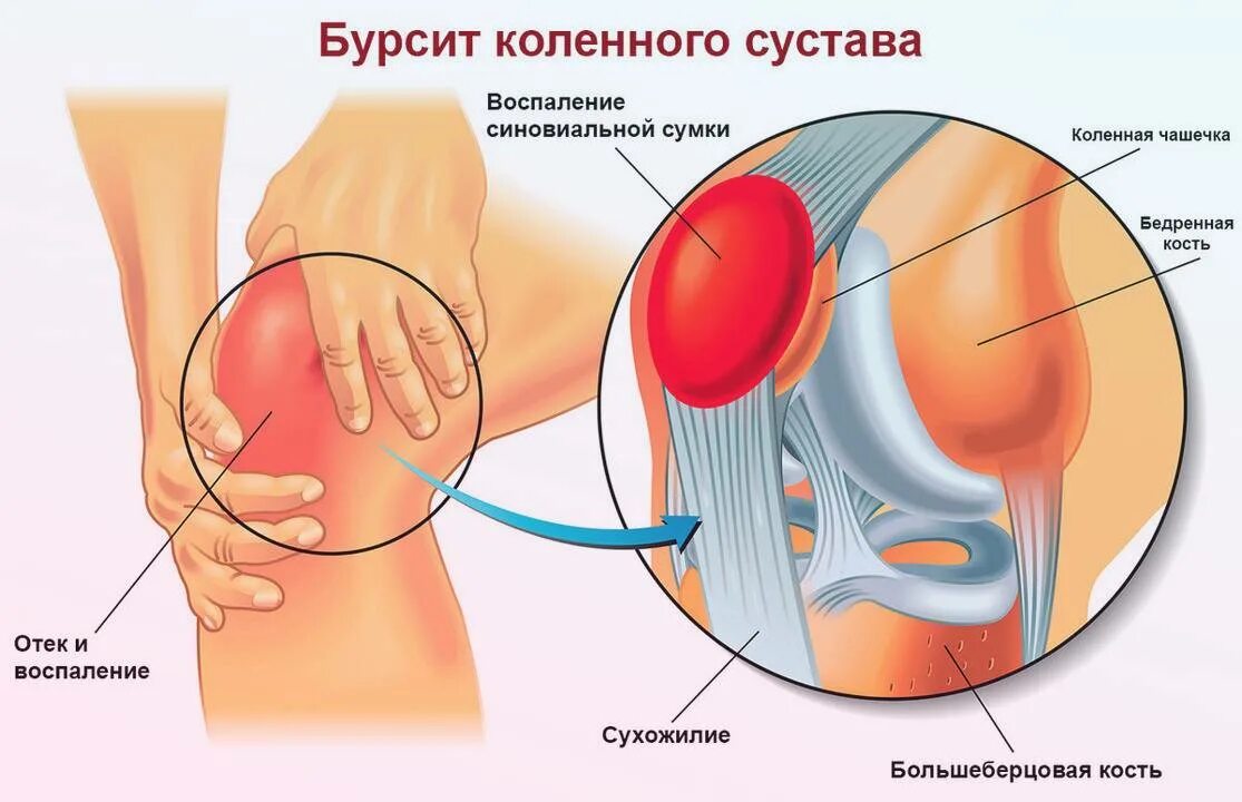 Бурсит коленного сустава что это такое