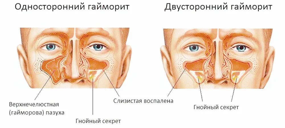 Острый двусторонний гайморит, фронтит. Острый двусторонний Гнойный синусит. Хронический двусторонний Гнойный гайморит. Двусторонний экссудативный гайморит.