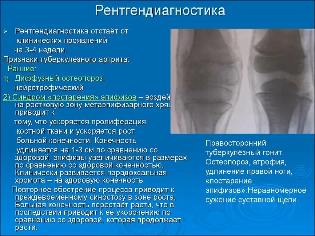 Коленный туберкулез