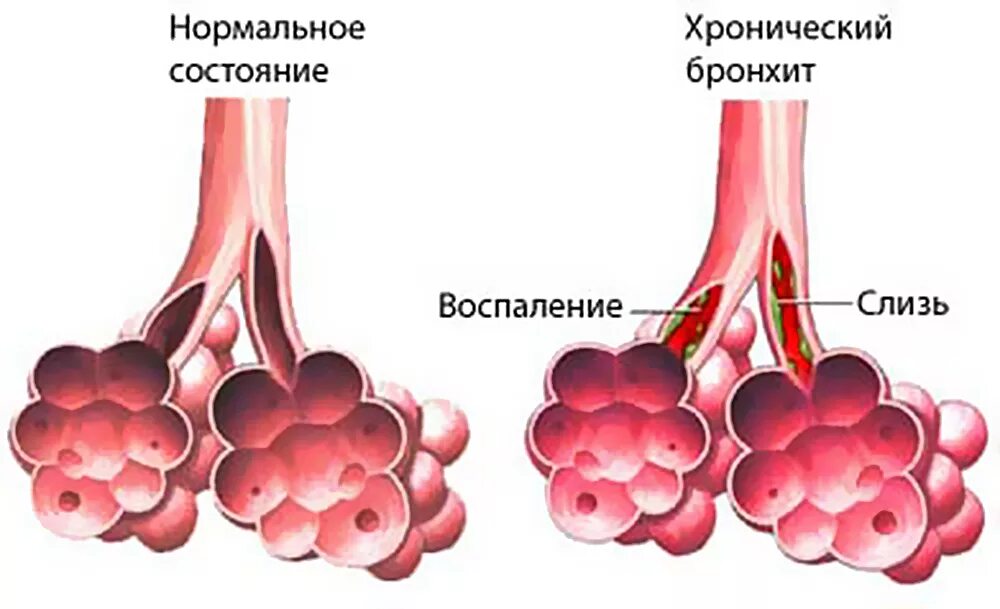 Гипертрофический бронхит. Воспаление хронического бронхита. Хроническое воспаление бронхов. Сухой кашель при хроническом бронхите обусловлен. Острый и хронический бронхит.