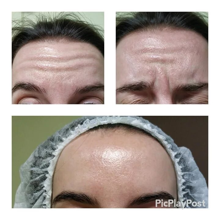 Уколы Botox метро Нивки, Киев цена, отзывы на