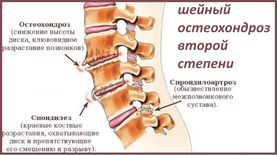 Спондилез поясничного отдела что симптомы и лечение. Спондилез с3-с7 позвонков. спондилоартроз c6-th1. спондилёз поясничного отдела позвоночника что это такое. спондилёз пояснично-крестцового отдела l1 l2.