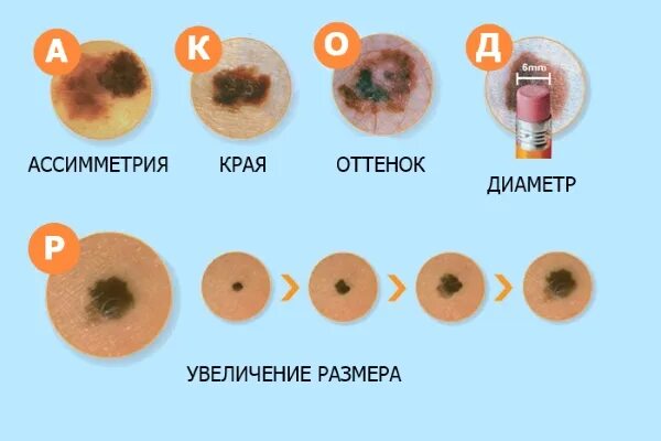 Родинка читать по главам. Опасные родинки меланома. IGE-меланома (злокачественное новообразование кожи).. Малигнизированная меланома. Меланома на родимом пятне.