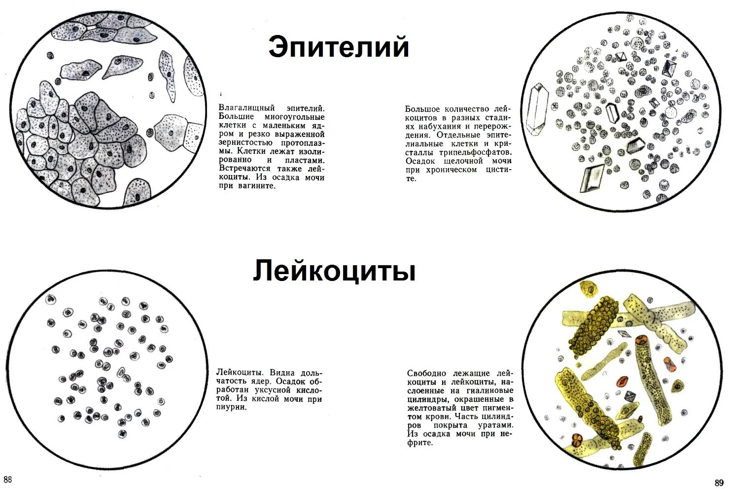 Эритроциты в 1 мл мочи. Лейкоциты микроскопия в моче норма. Эритроциты в моче микроскопия. Микроскопия мочи лейкоциты и эритроциты. Микроскопия осадка мочи лейкоциты норма.