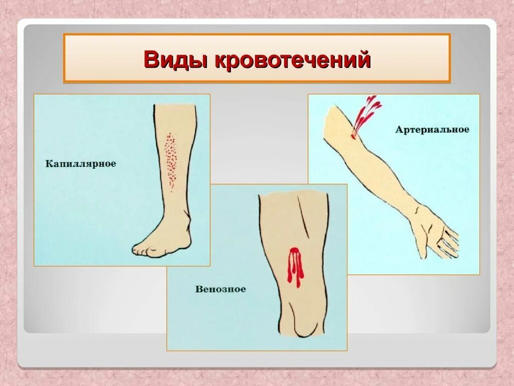 Какое кровотечение наблюдается. Артериальное венозное и капиллярное кровотечение. Виды кровотечений артериальное венозное капиллярное. Артериальное,венозное капилляр ое кровотечение. Видыг крвотечение.