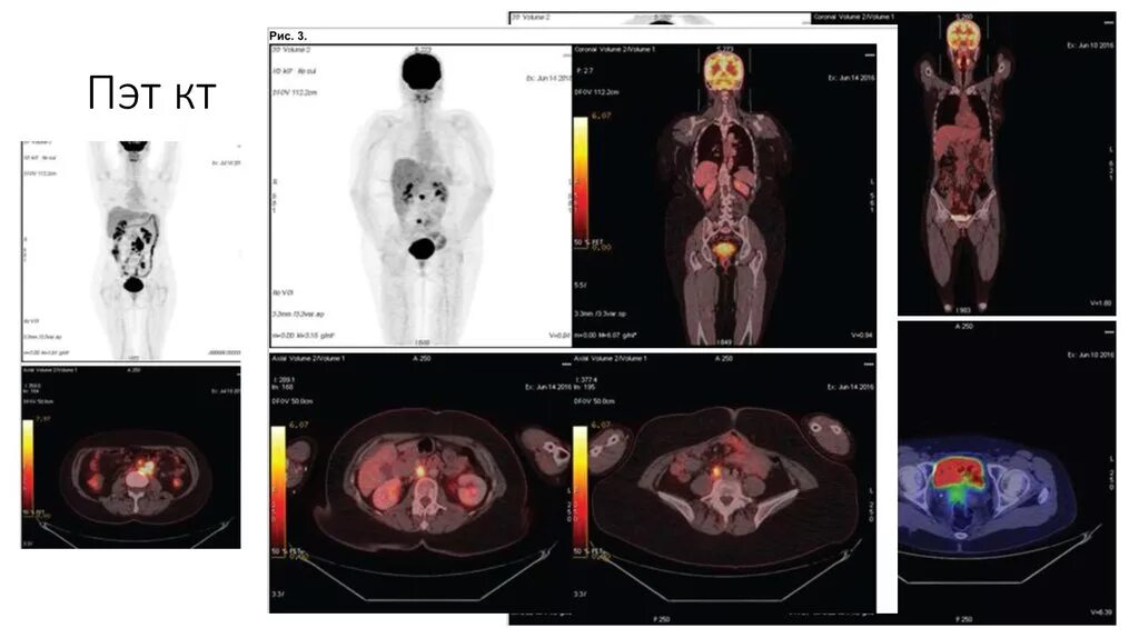 Кт после химиотерапии. ПЭТ кт заключение. Протокол ПЭТ кт. ПЭТ кт Орел.
