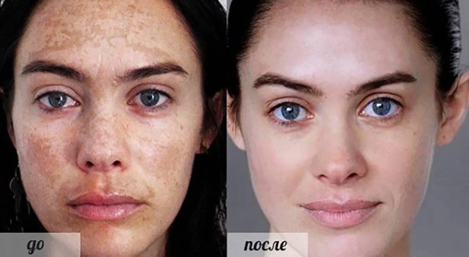 Эффект после лечения. Пигментные пятна на лице до и после. Пигментация кожи до и после. Пигментация кожи лица до после.