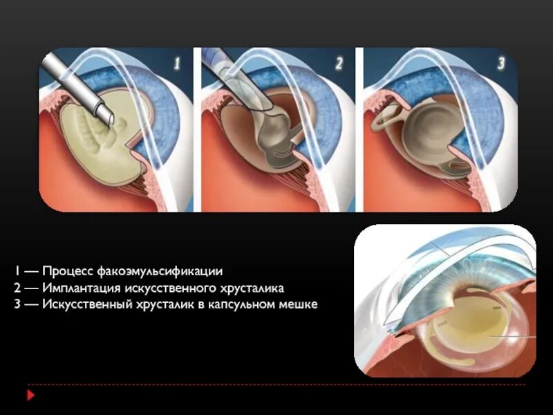 Замена хрусталика как происходит
