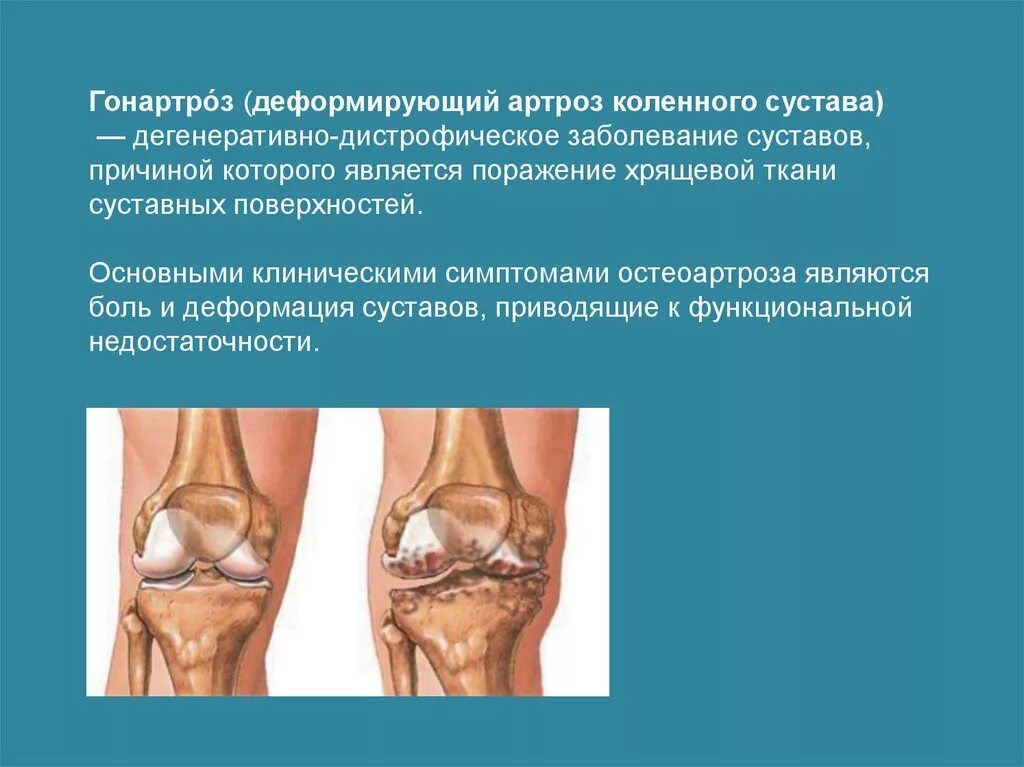 Изменения в коленных суставах. Деформирующий артроз коленного сустава. Дегенеративные поражения суставов. Дистрофические изменения коленного сустава. Деформирующий гонартроз.