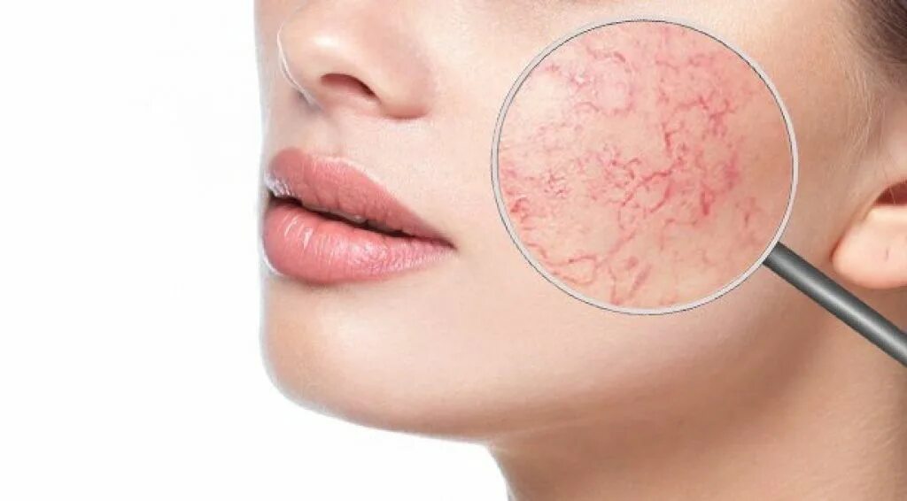 Чувствительная кожа. Телеангиэктазии, купероз. Телеангиоэктазии розацеа. Купероз сосудистые звездочки. Сетка на лице как избавиться.